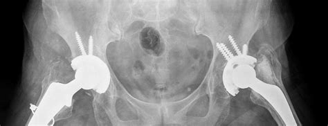hip replacement surgery greenwich|Joint Surgery .